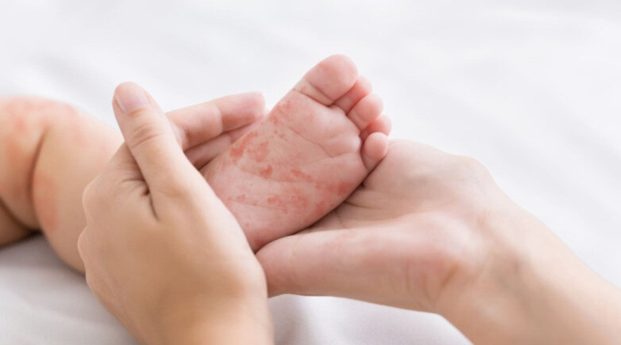 ΙΛΑΡΑ: ΠΑΓΚΟΣΜΙΟΣ ΣΥΝΑΓΕΡΜΟΣ ΠΑΡΑ ΤΗΝ ΥΠΑΡΞΗ ΕΜΒΟΛΙΟΥ